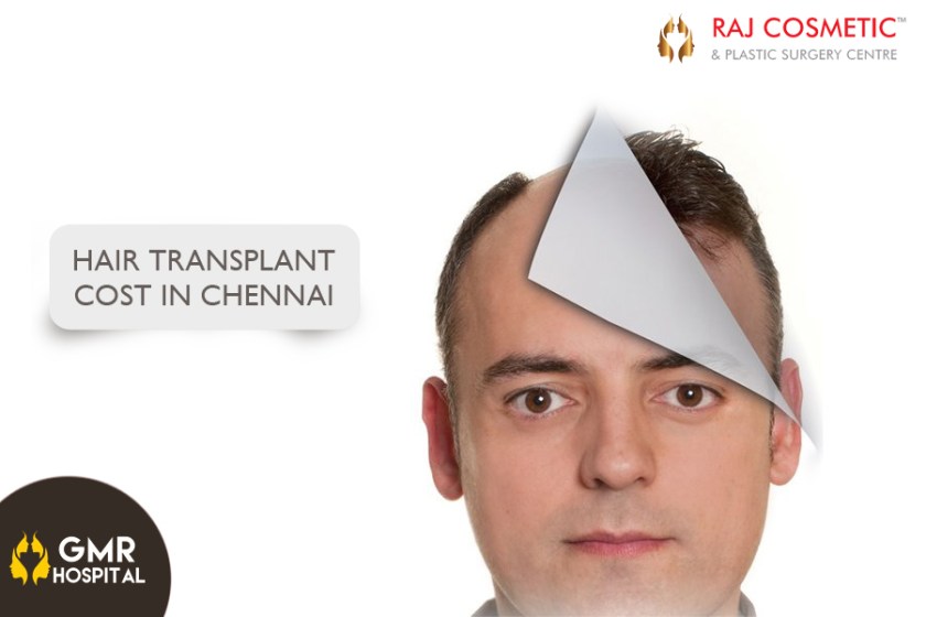 hair-transplant-cost-in-chennai
