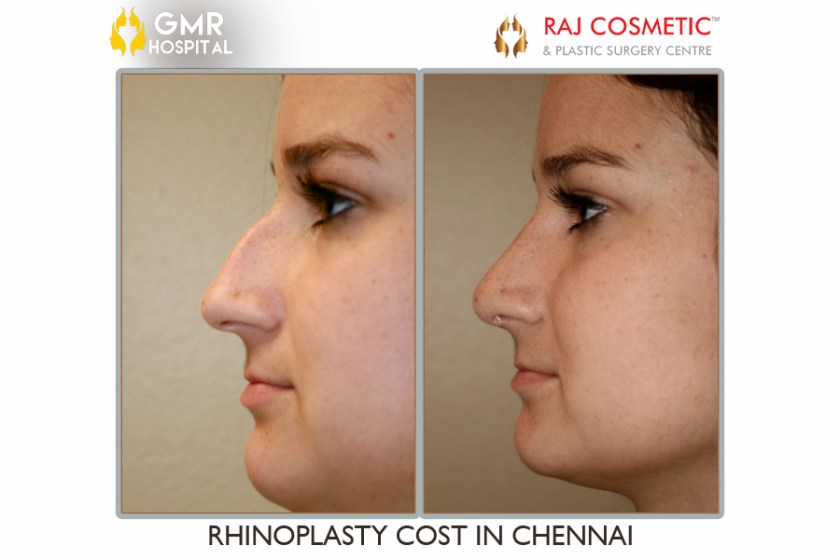 rhinoplasty-cost-in-chennai